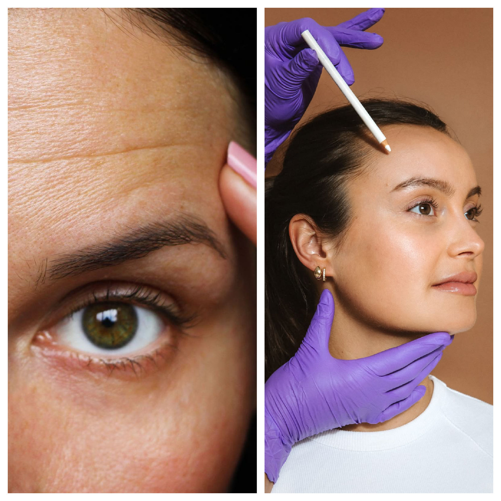botox smooth forehead
