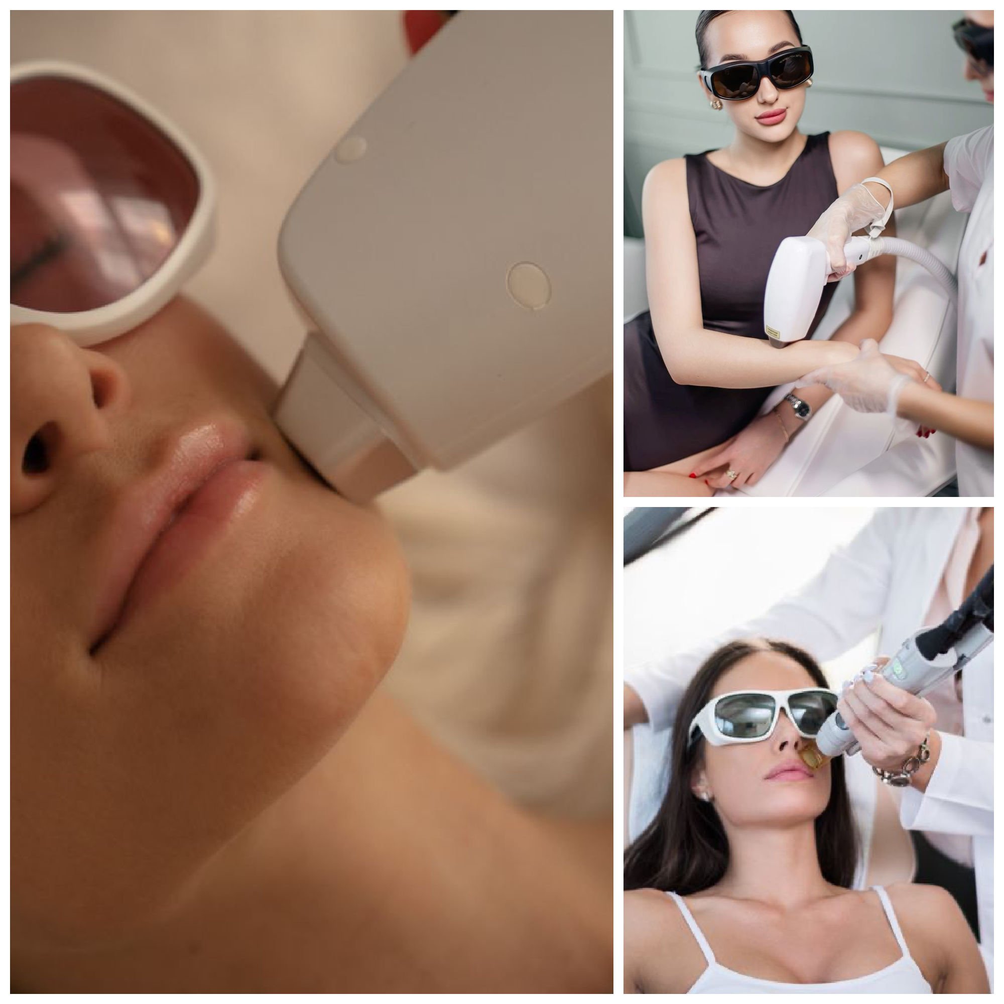 laser hair removal