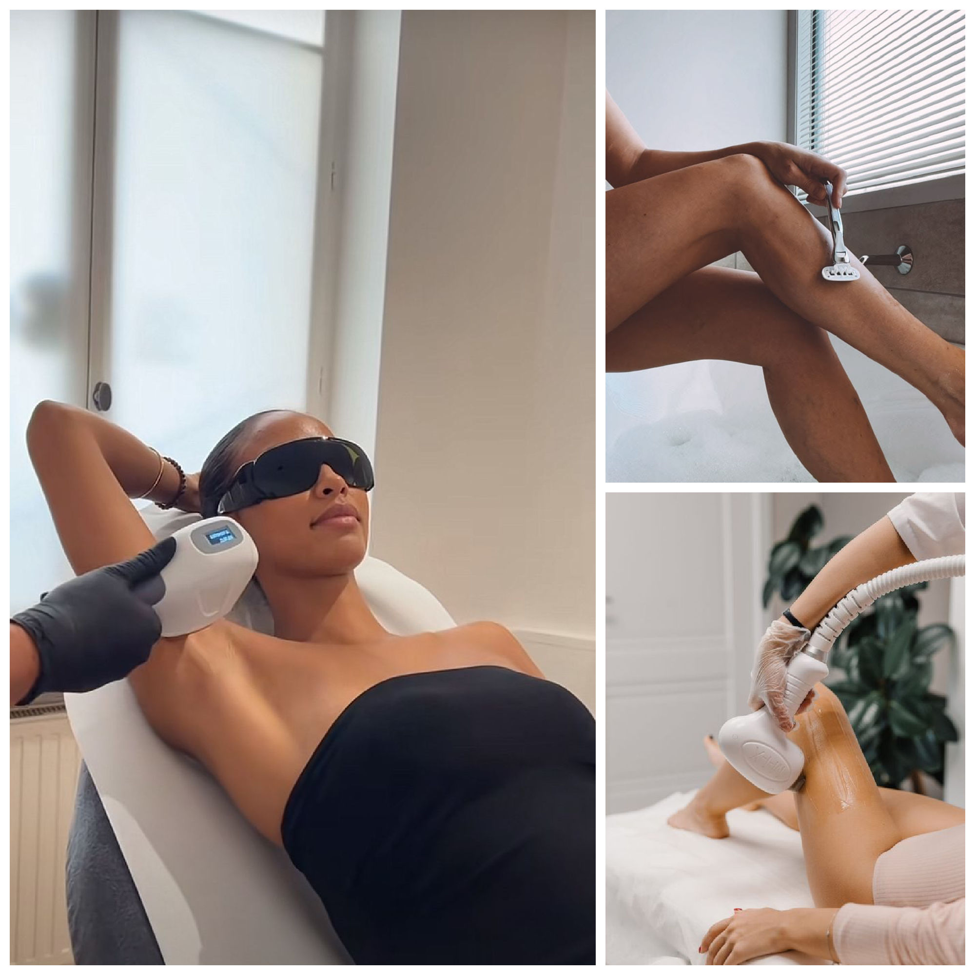 laser hair removal