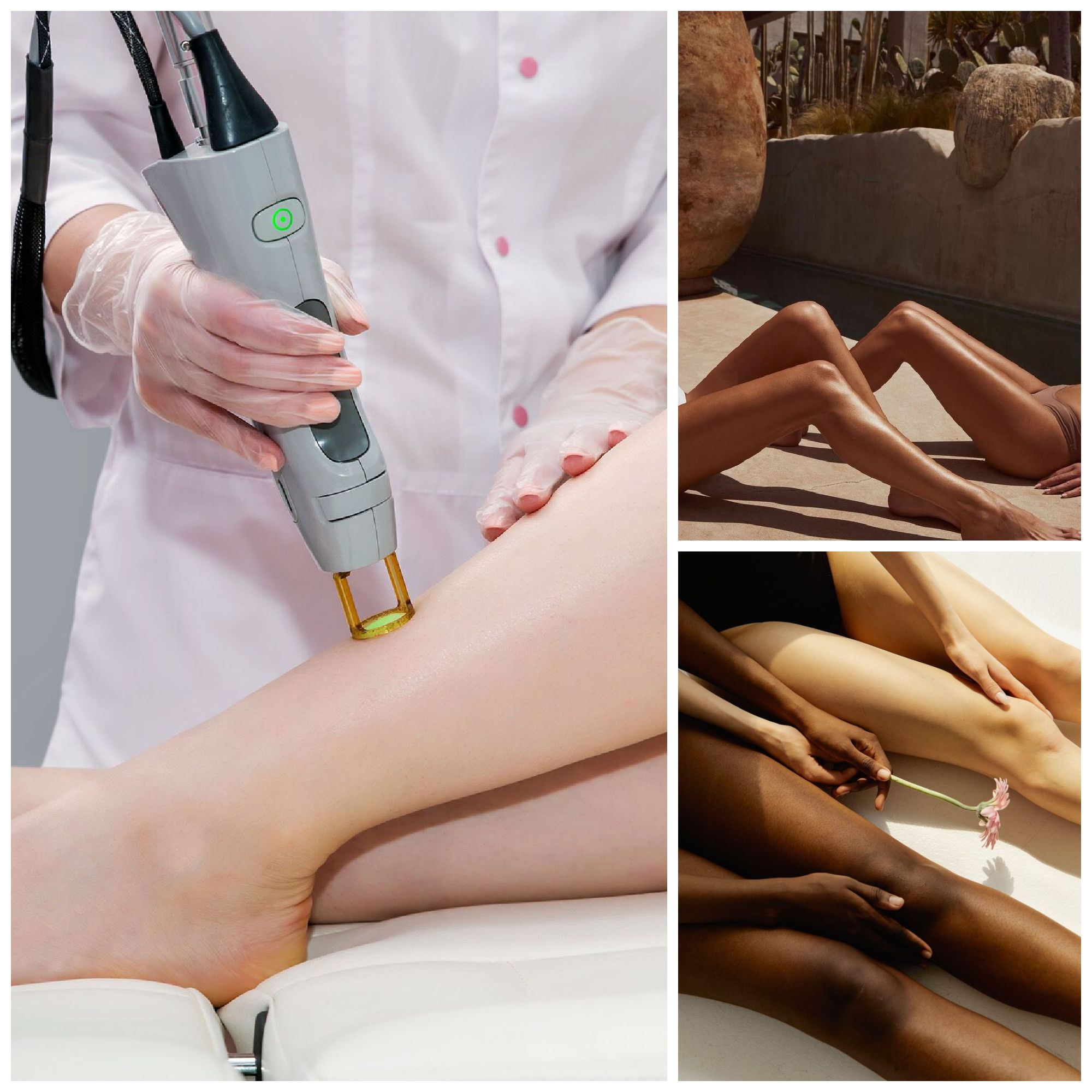 laser hair removal